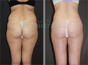 Liposuction Patient 35