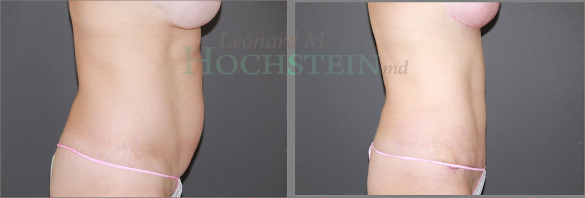 Tummy Tuck Patient