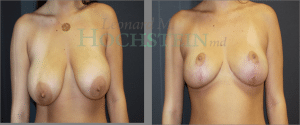 Breast Reduction/Lift (No Implants) Patient