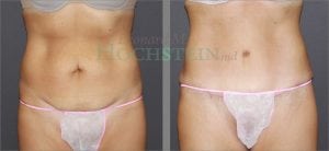 Tummy Tuck Patient