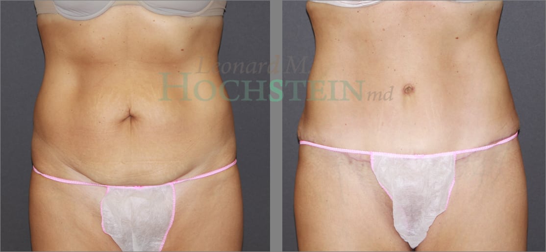 Tummy Tuck Patient