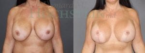 Breast Lift With Implants Patient