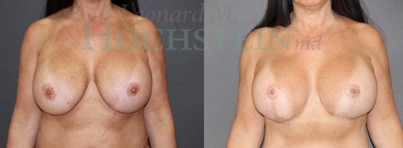 Breast Lift With Implants Patient