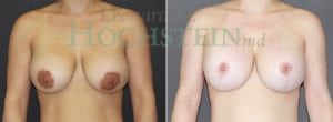 Breast Revision Patient