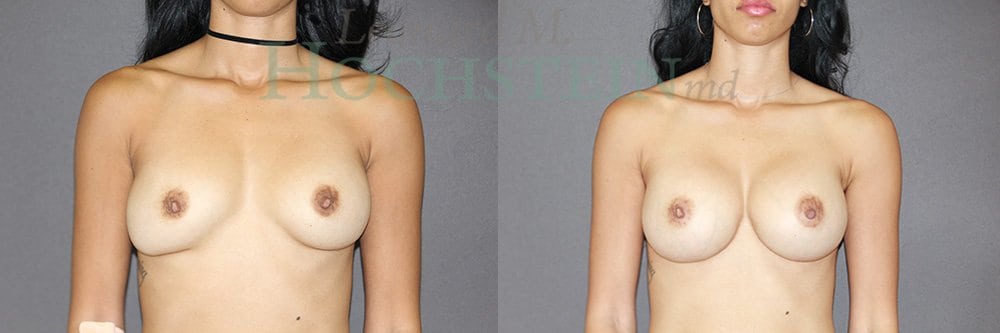 Breast Revision Patient