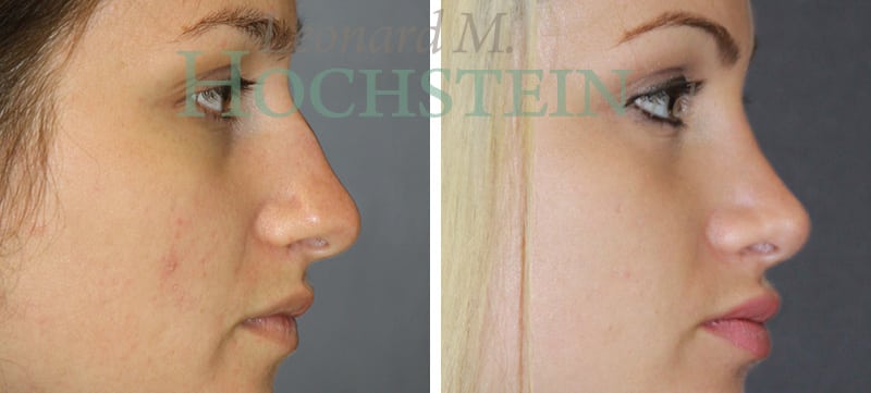 Rhinoplasty Patient