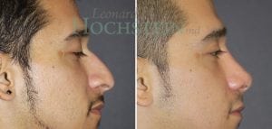 Rhinoplasty Patient