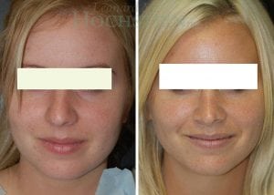 Rhinoplasty Patient