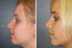 Rhinoplasty Patient