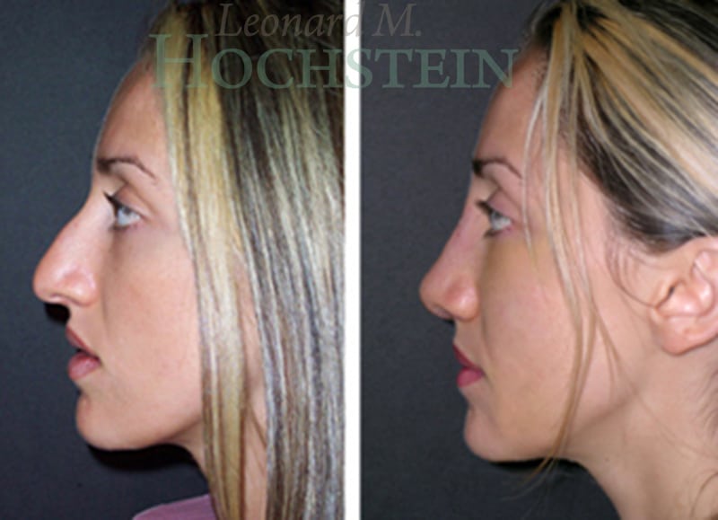 Rhinoplasty Patient