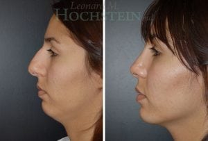 Rhinoplasty Patient 07
