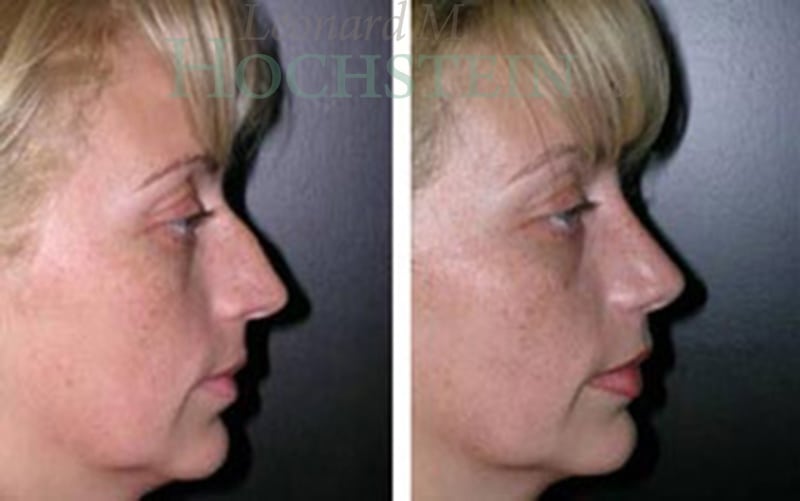 Rhinoplasty Patient