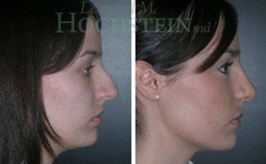 Rhinoplasty Patient 10
