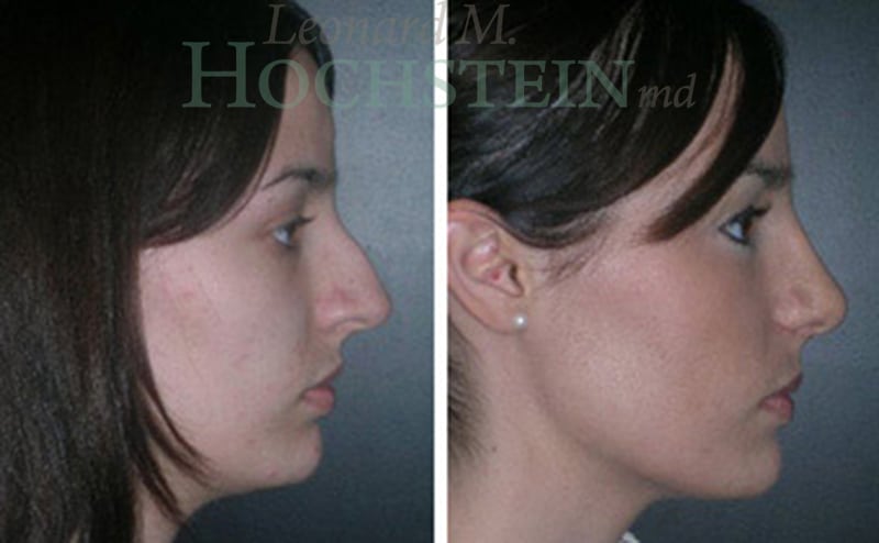 Rhinoplasty Patient