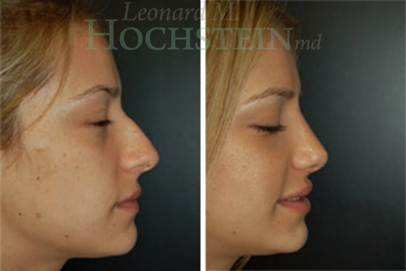 Rhinoplasty Patient
