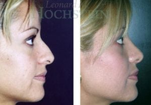 Rhinoplasty Patient 12