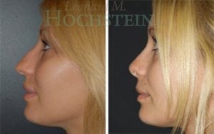 Rhinoplasty Patient