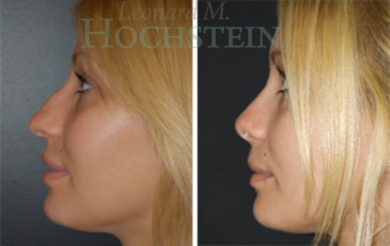 Rhinoplasty Patient