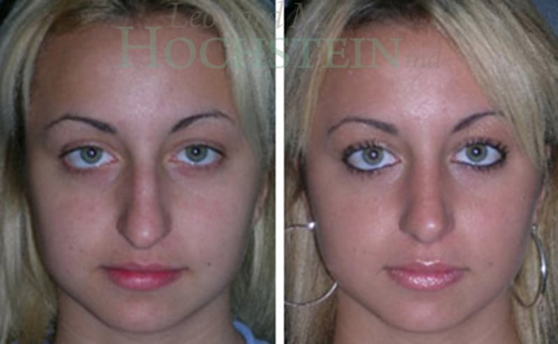 Rhinoplasty Patient
