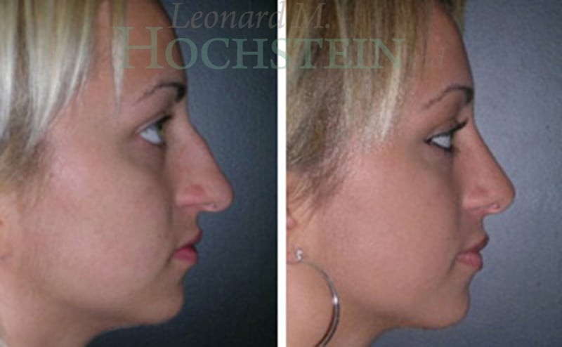 Rhinoplasty Patient