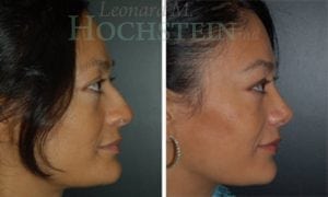 Rhinoplasty Patient