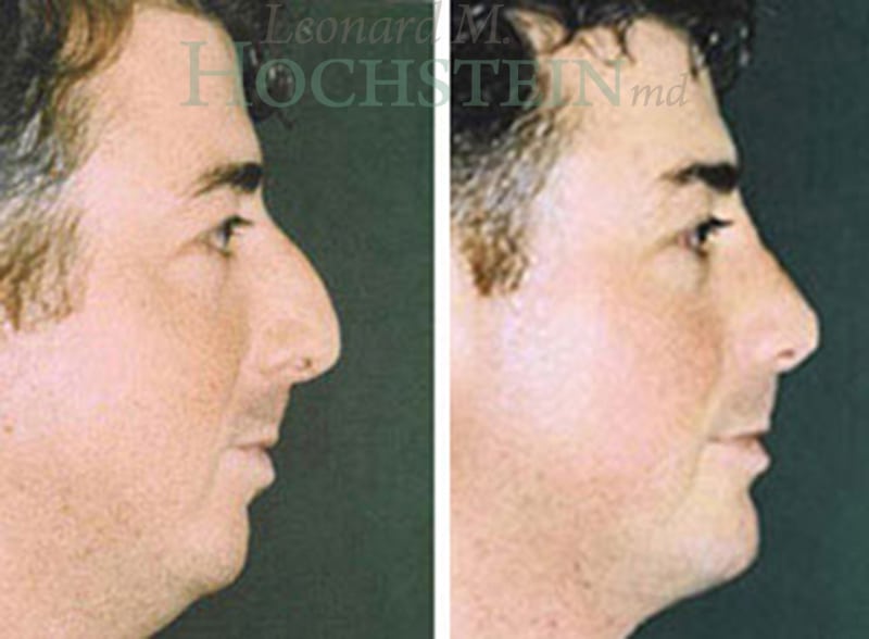 Rhinoplasty Patient