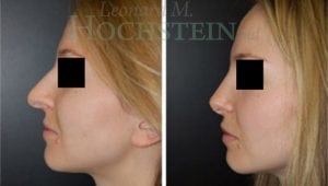 Rhinoplasty Patient