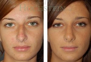 Rhinoplasty Patient