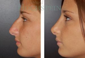 Rhinoplasty Patient