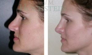 Rhinoplasty Patient 19