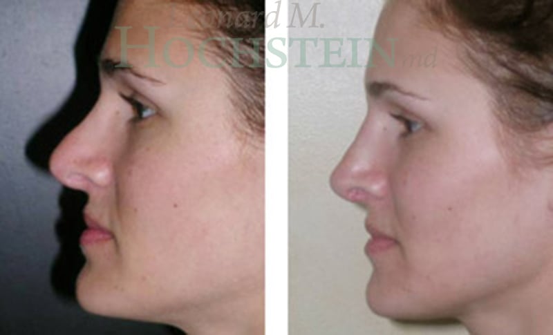 Rhinoplasty Patient