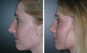 Rhinoplasty Patient