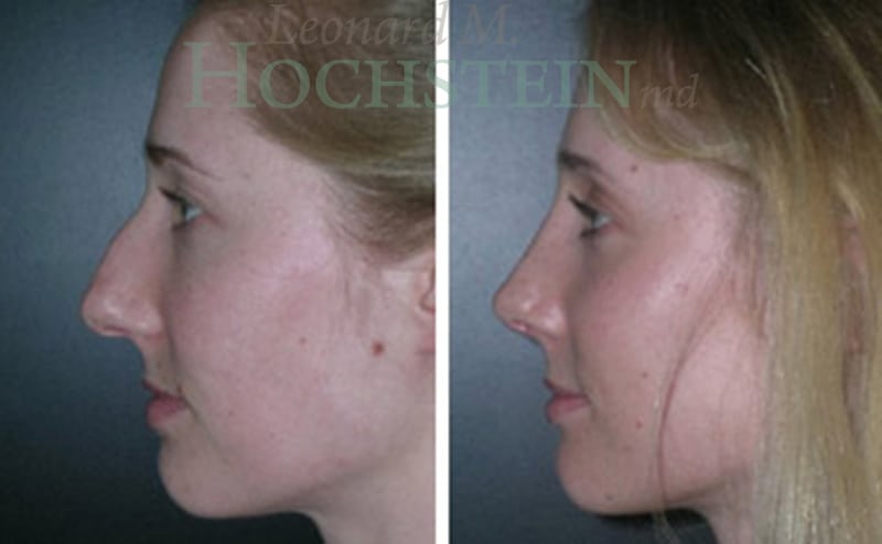 Rhinoplasty Patient