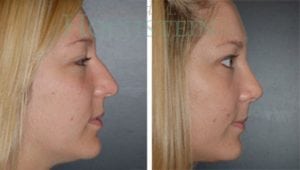 Rhinoplasty Patient 23