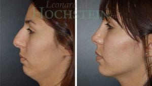 Rhinoplasty Patient 24