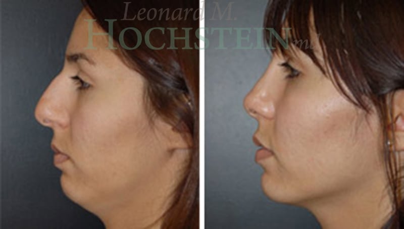 Rhinoplasty Patient