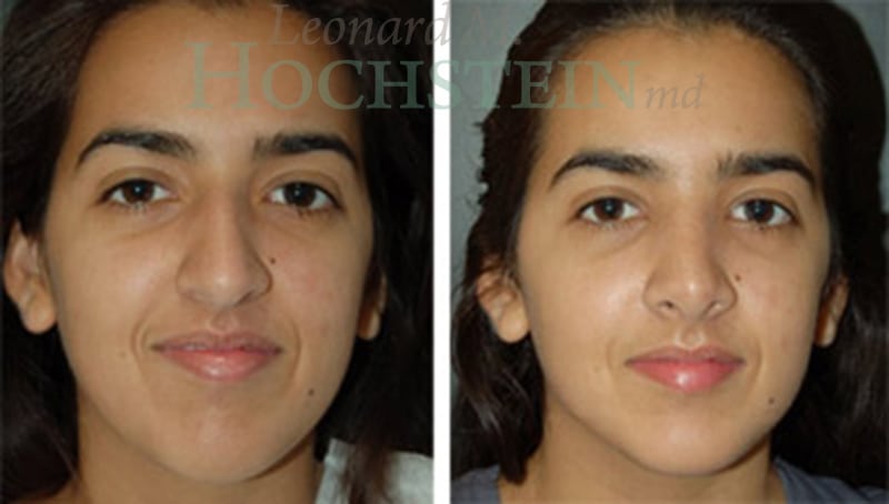 Rhinoplasty Patient