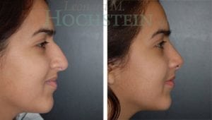 Rhinoplasty Patient
