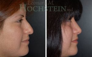Rhinoplasty Patient 27