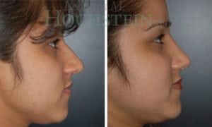 Rhinoplasty Patient 28