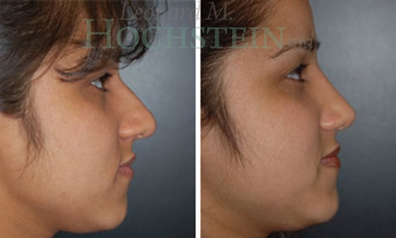 Rhinoplasty Patient