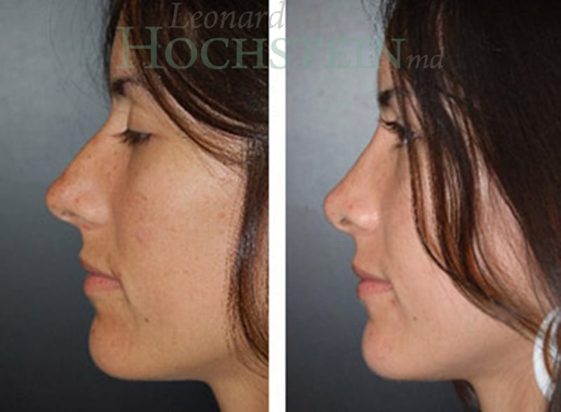 Rhinoplasty Patient