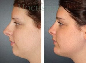 Rhinoplasty Patient
