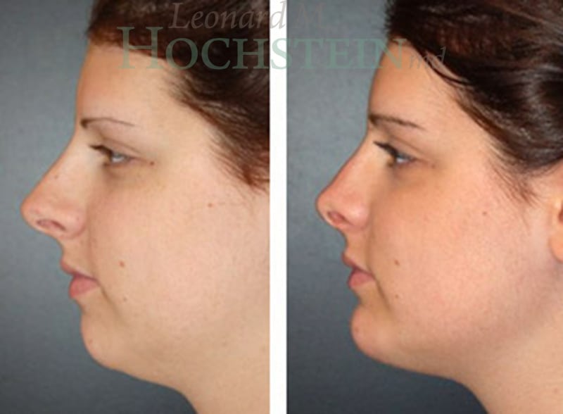 Rhinoplasty Patient