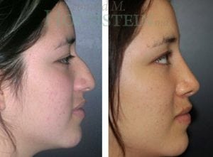 Rhinoplasty Patient