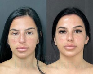 Rhinoplasty Patient 72