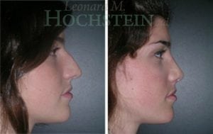 Rhinoplasty Patient 34
