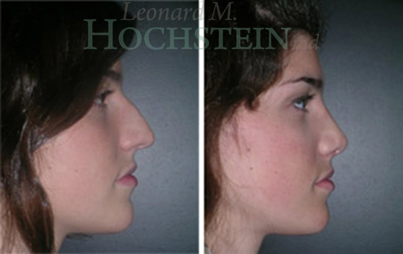 Rhinoplasty Patient