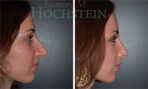 Rhinoplasty Patient 35