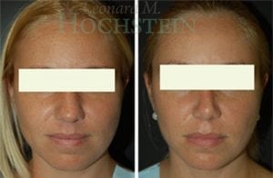 Rhinoplasty Patient 36